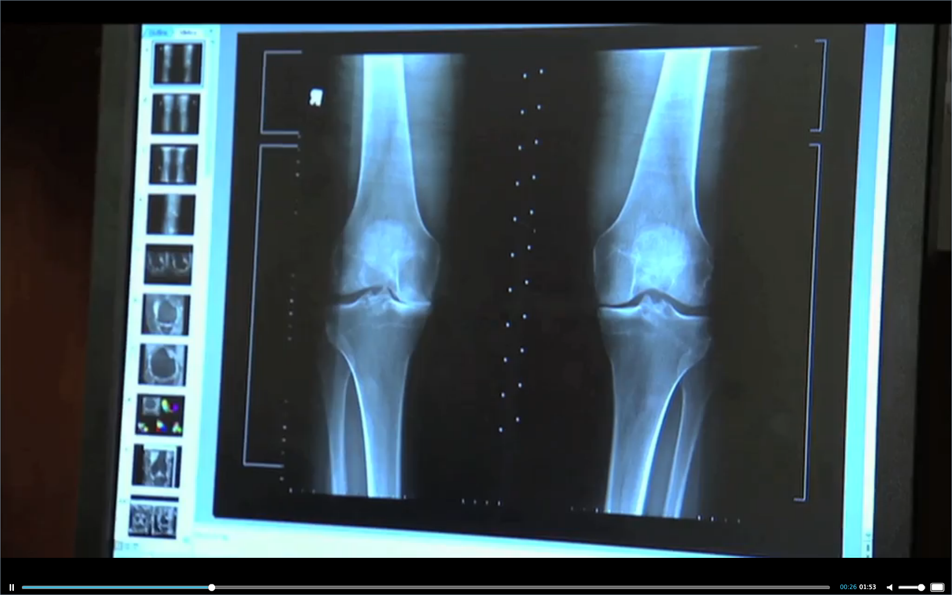 Repeat Bone Mineral Density Tests Did Not Predict Future Fracture Risk Thumbnail