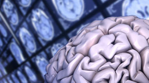 Modafinil Fails to Ease Brain Tumor-Related Symptoms Thumbnail