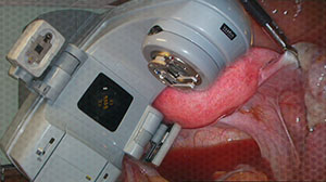 No Survival Benefit with Pelvic Radiation for Early Endometrial Cancer Thumbnail