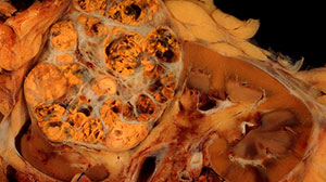 Mixed Results Seen with Tivozanib in Metastatic Renal Cell Carcinoma Thumbnail