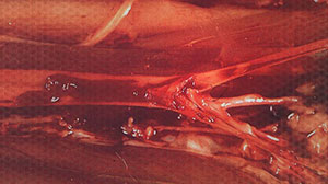 Port-A-Cath-Related Thrombosis Common in Pediatric Oncology Patients Thumbnail