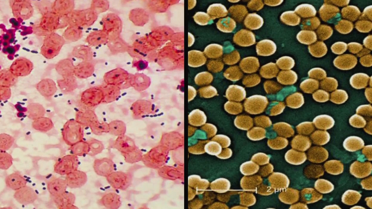 Wearing Gloves and Gowns in the Intensive Care Unit Can Decrease Antibiotic Resistant MRSA Infection Thumbnail