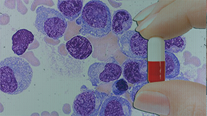 Pomalidomide-Dexamethasone Beneficial in Refractory Multiple Myeloma Thumbnail