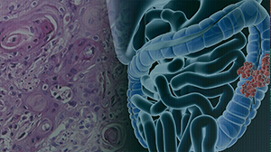 Adjuvant Chemotherapy Helpful for Stage III Mucinous Colorectal Cancer Thumbnail