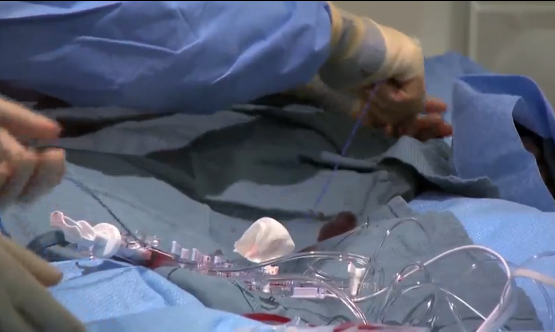 Longer Duration of Blood-Thinning Medications May Not Be Necessary for Patients with Newer Generation Coronary Stents Thumbnail