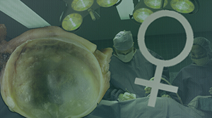 Platinum-Combination Chemotherapy Improves Survival in Recurrent Ovarian Cancer Thumbnail
