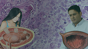 Delay in Diagnosis of Bladder Cancer Longer in Women than Men Thumbnail