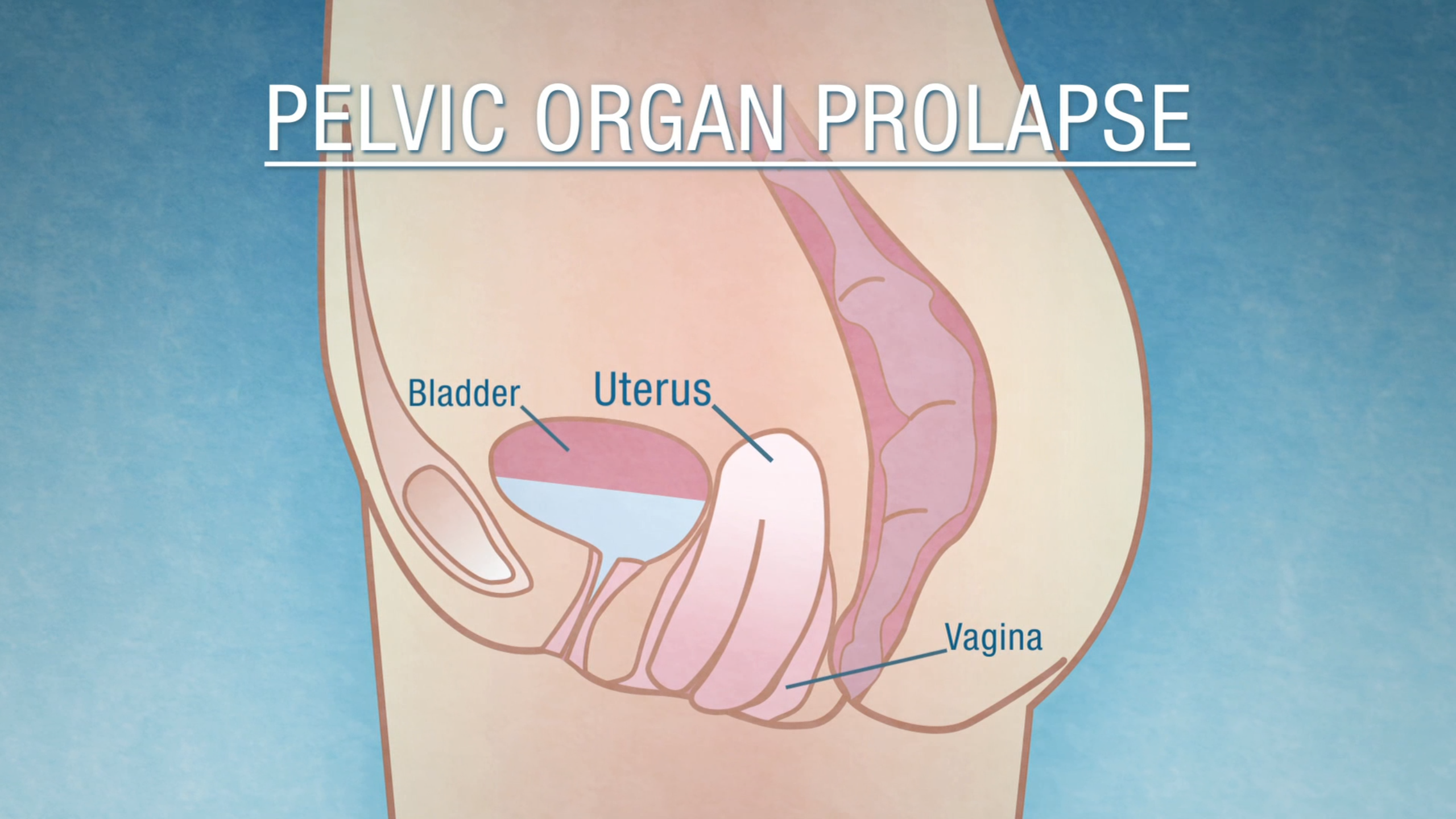 Two Surgeries that May Help Correct a Common Female Condition Have Similar Outcomes Thumbnail