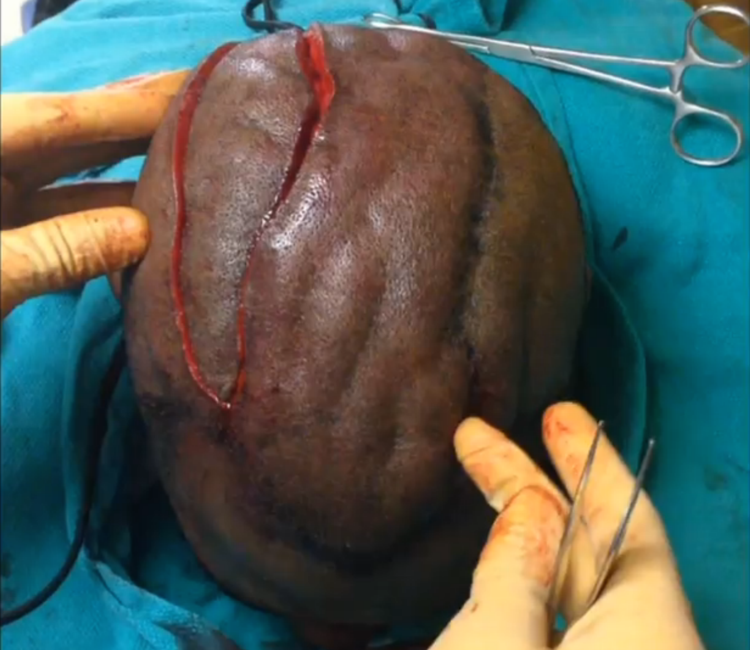 ‘Scalping’ Surgery Only Known Treatment for Rare Cutis Verticis Gyrata Condition Thumbnail