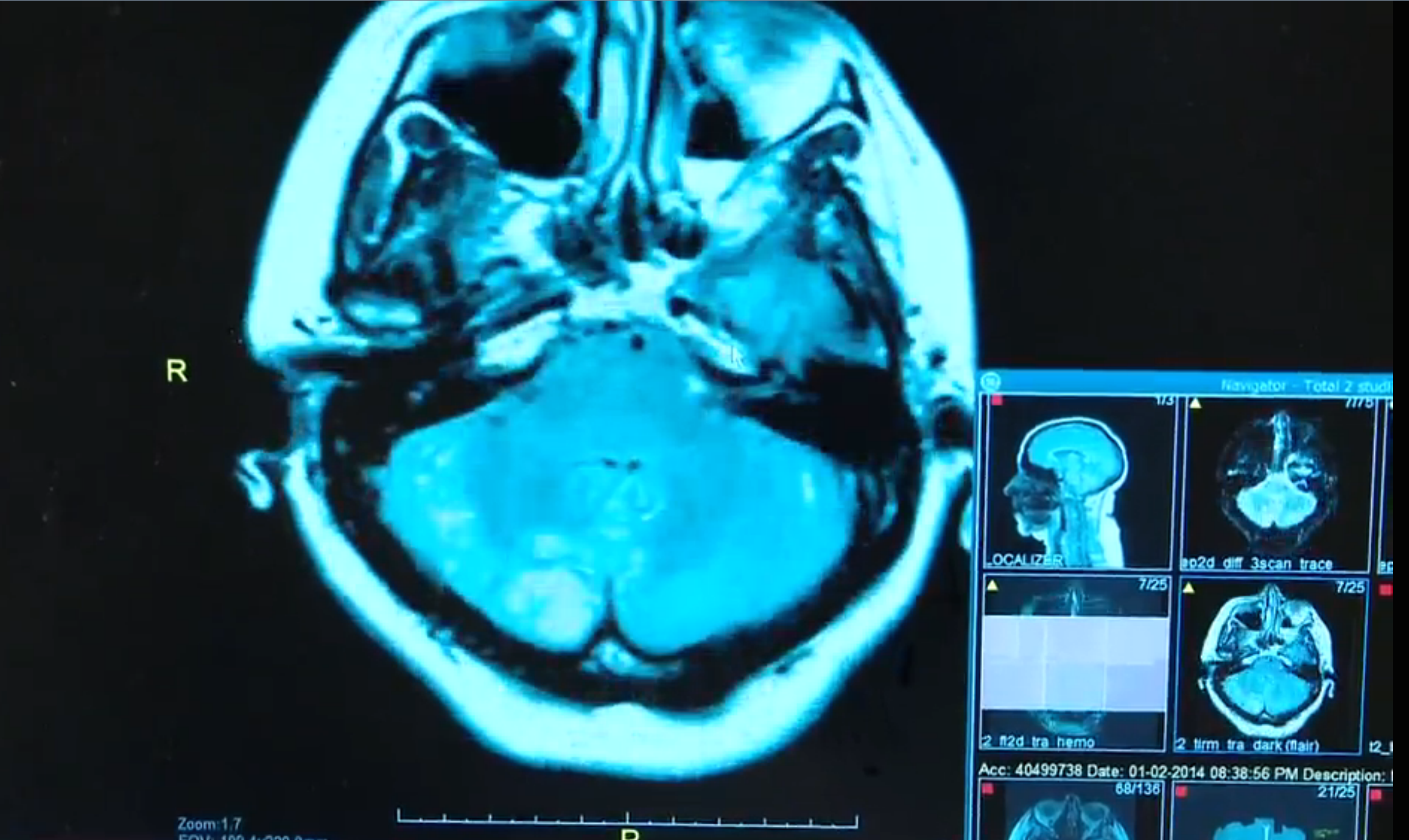 Door-to-Needle Time Under 60 Min with Clot Dissolver Saves Stroke Victims Thumbnail