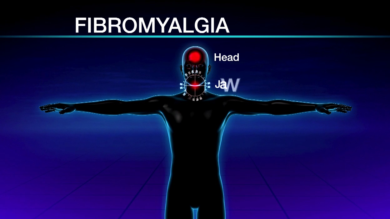 Is There a Standard of Treatment for Fibromyalgia’s Mysterious Symptoms? Thumbnail