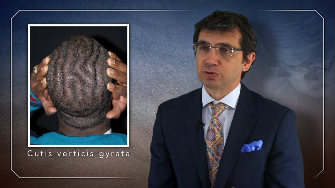Surgery for Rare ‘Brainy’ Scalp Changes Man’s Life Thumbnail