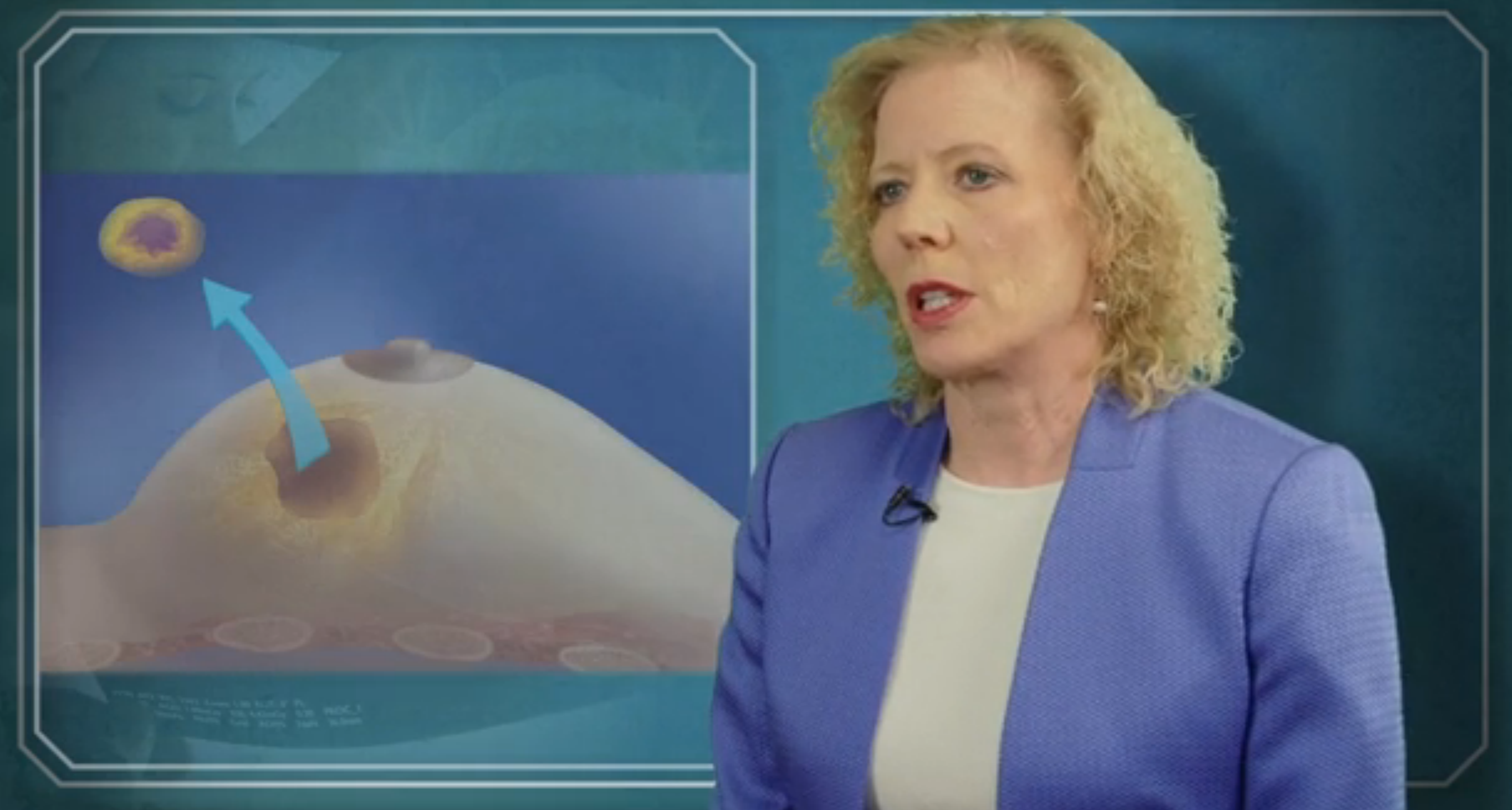 Breast Cancer Surgery? or Breast Lift? How Your Patients Can Have Both Thumbnail