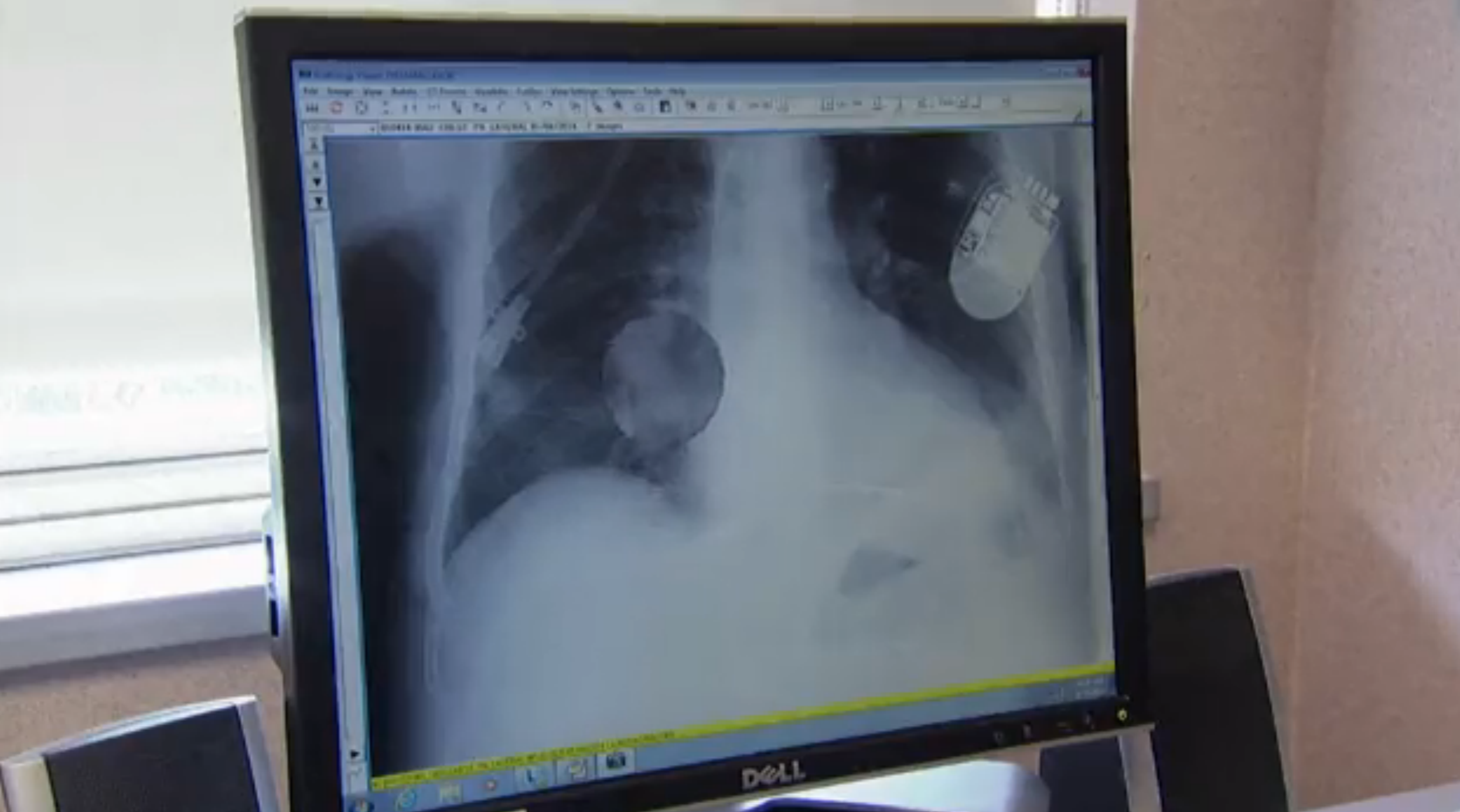 Benefit of Azithromycin for Pneumonia Outweighs Increased Heart Attack Risk Thumbnail
