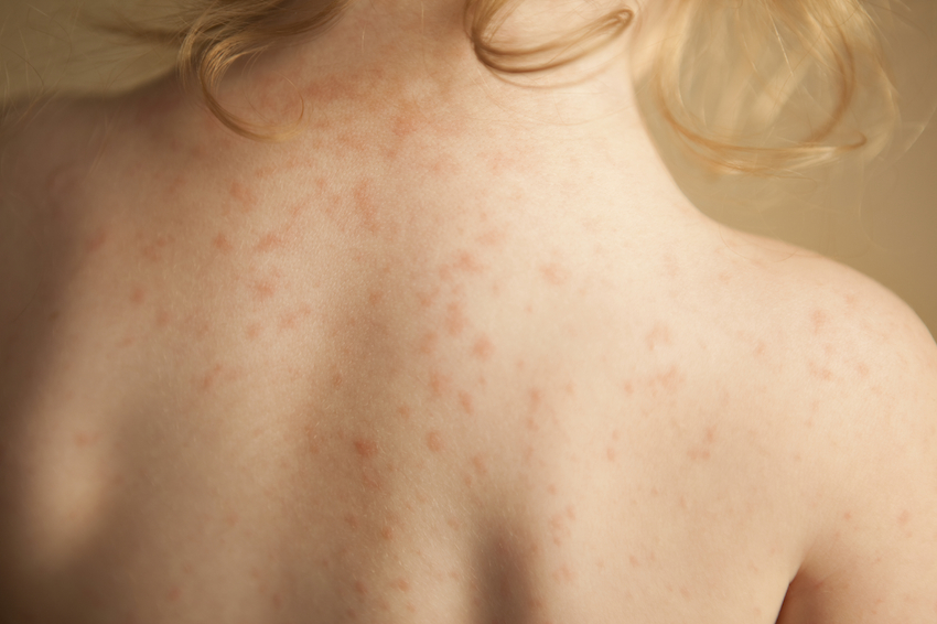 Case Study: A Simple Explanation for Intractable Pruritus Thumbnail
