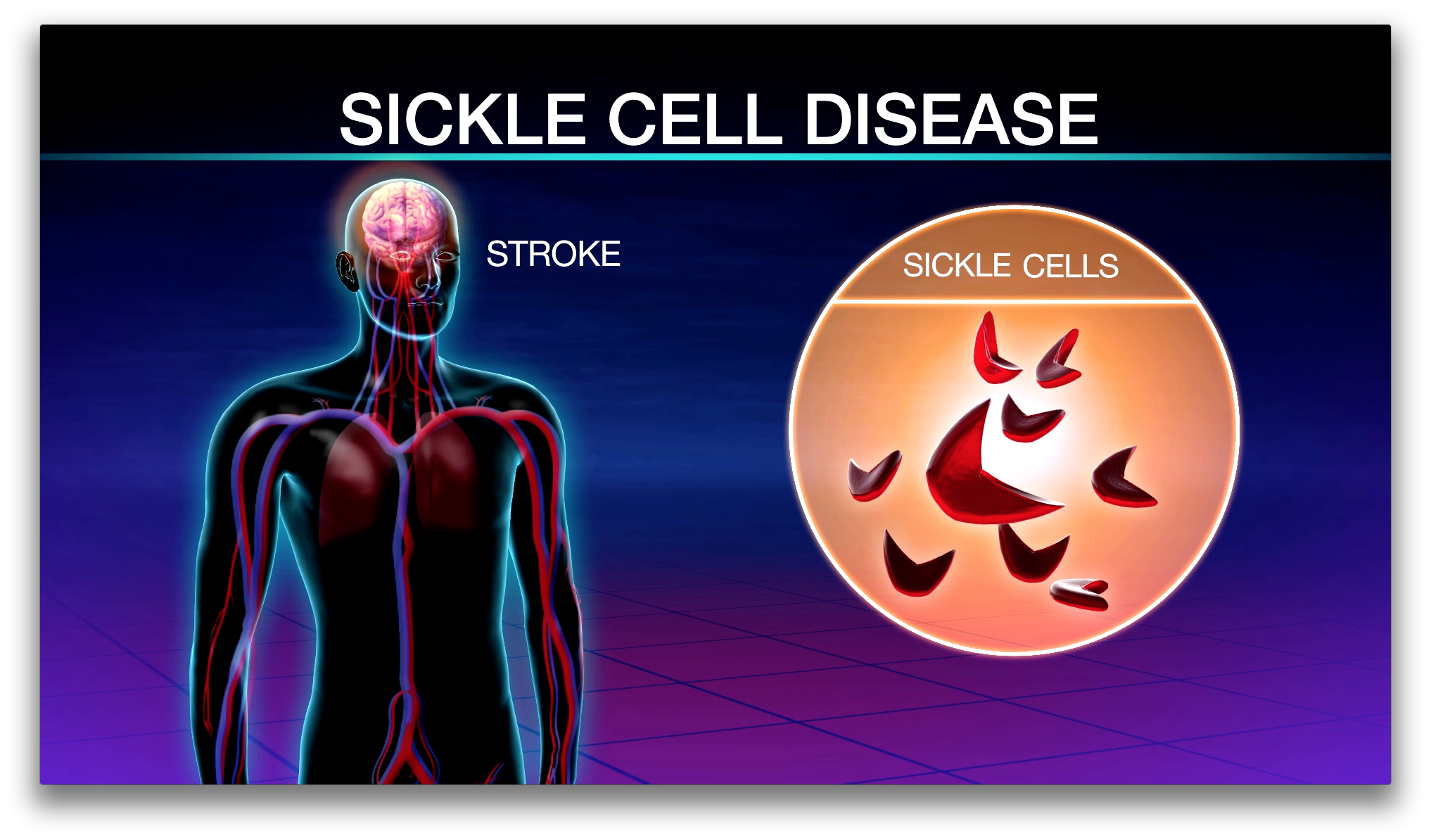Can Bone Marrow Transplants Improve Outcomes for Adults with Sickle Cell Disease? Thumbnail