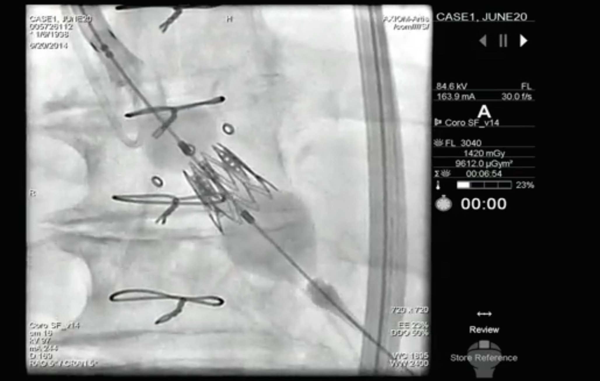 ‘Valve-in-Valve’ Catheter Procedure Successfully Replaces Failed Heart Valve Implants Thumbnail