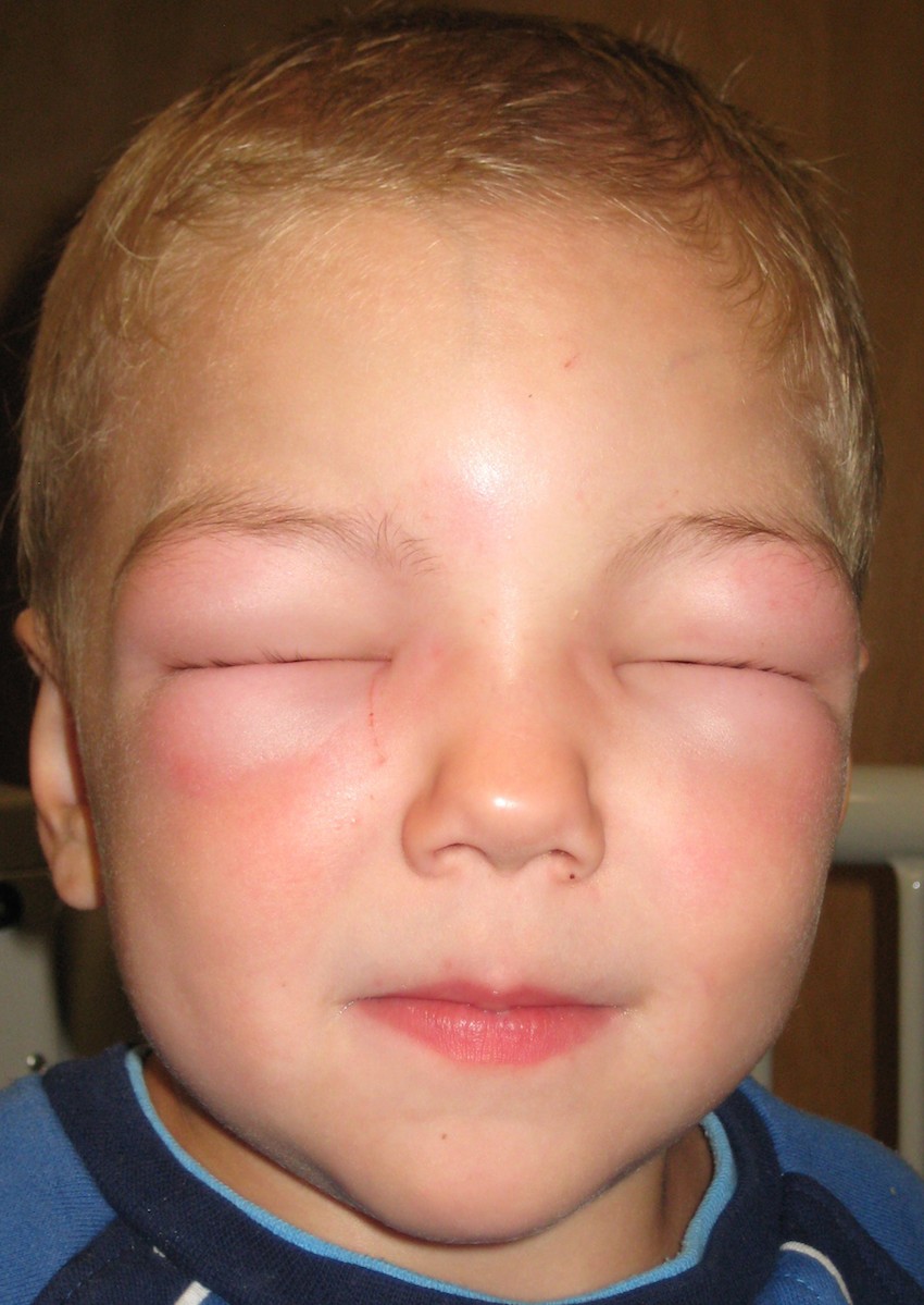 Case Study: Insect Sting Induced Anaphylaxis Thumbnail