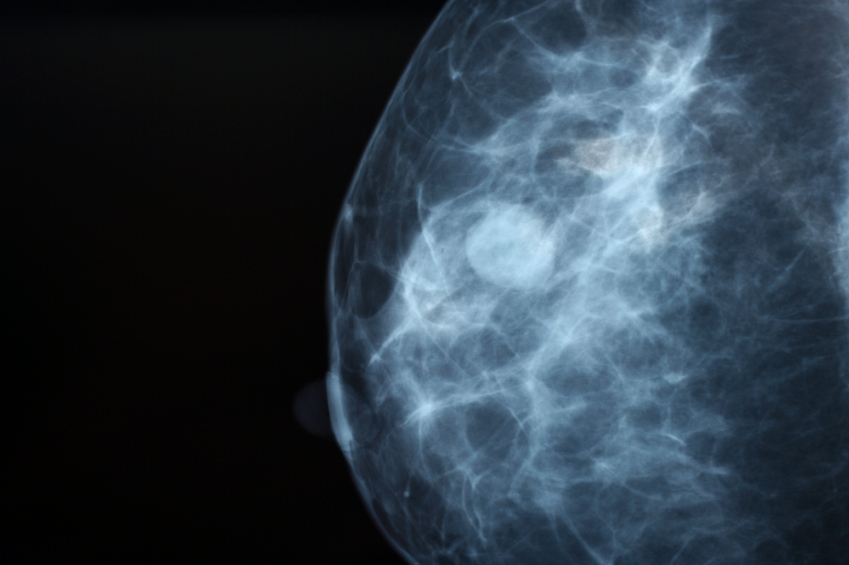 Breast Cancer Survival Rates Differ Based on Ethnicity, Race Thumbnail