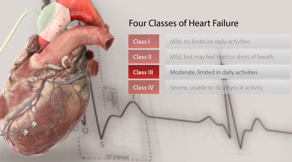 The C-Pulse Heart Assist Device: A Less Invasive Treatment for Heart Failure Thumbnail