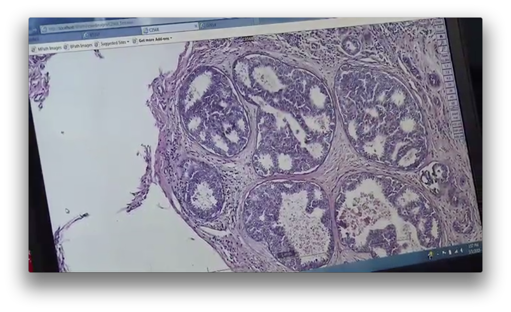 Study Examines Diagnostic Accuracy of Pathologists Interpreting Breast Biopsies Thumbnail
