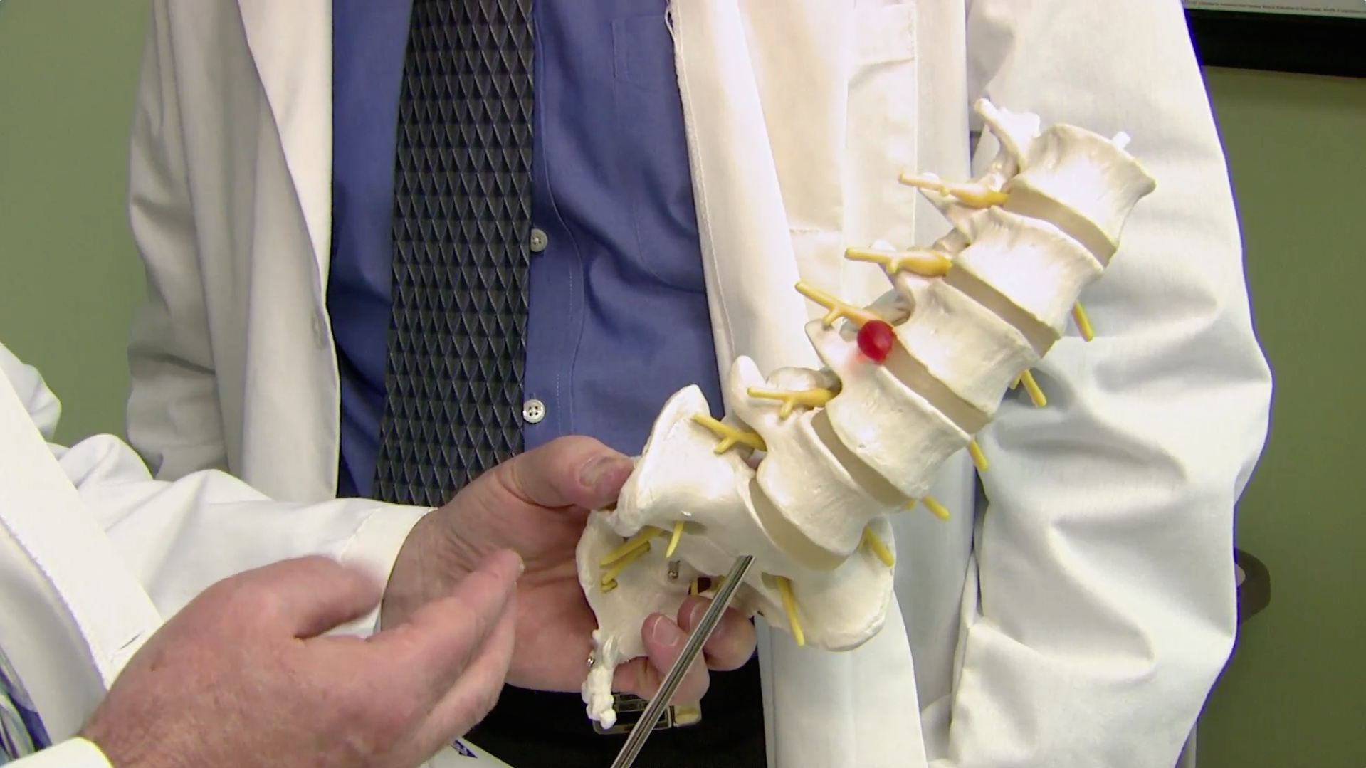 Oral Steroids Do Not Improve Sciatica Pain Thumbnail