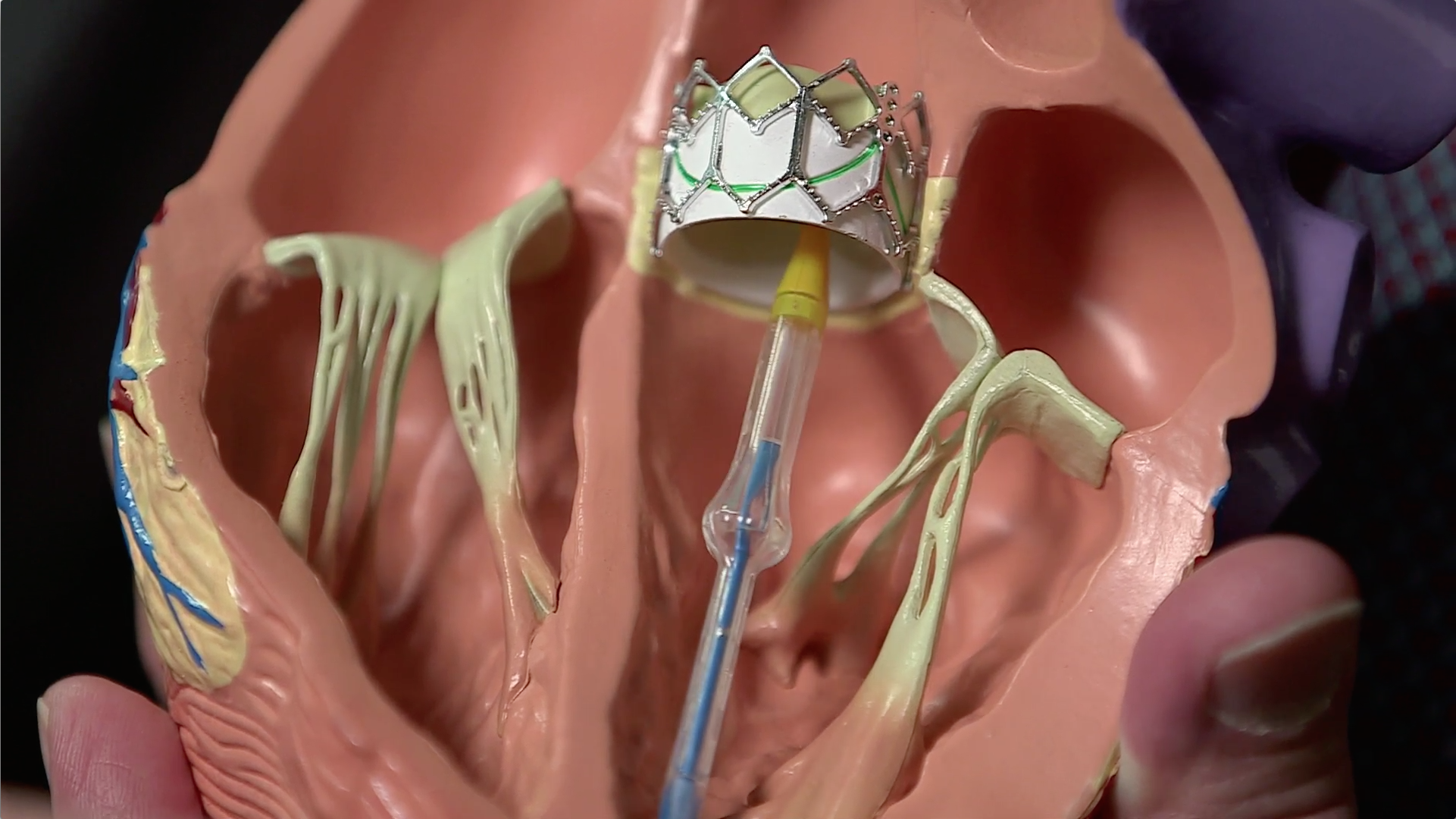 Outcomes for Non-Surgical Aortic Valve Replacement Thumbnail