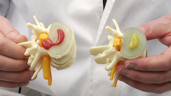 Replacement Fibrocartilage for Vertebrae Could be Cure for Back Pain Thumbnail