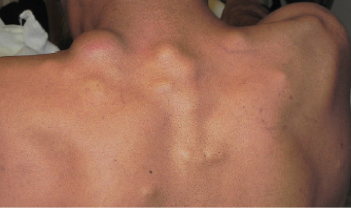 42YearOld Male with Painful Masses on Back & Neck The
