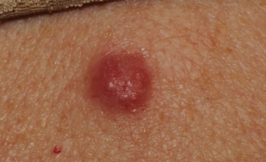 80 Year Old Female With Persistent Red Bump On Back The Doctors