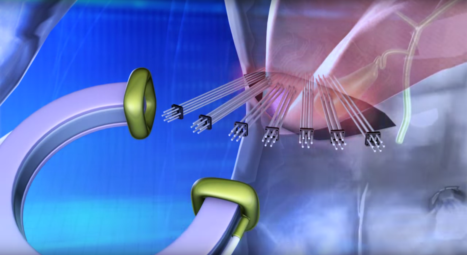 Electromagnetic Thermal Therapeutic Needles for Cancer Treatment Thumbnail