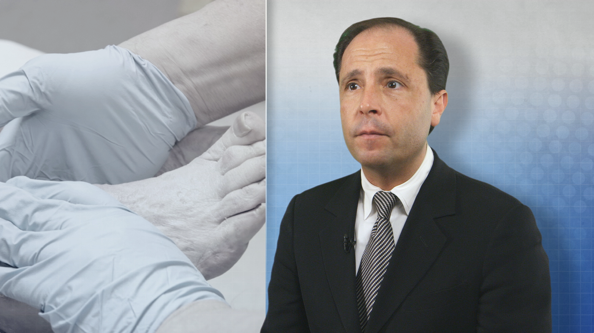 New dHACM Allograft for Wound Treatment Surpasses Peers Thumbnail