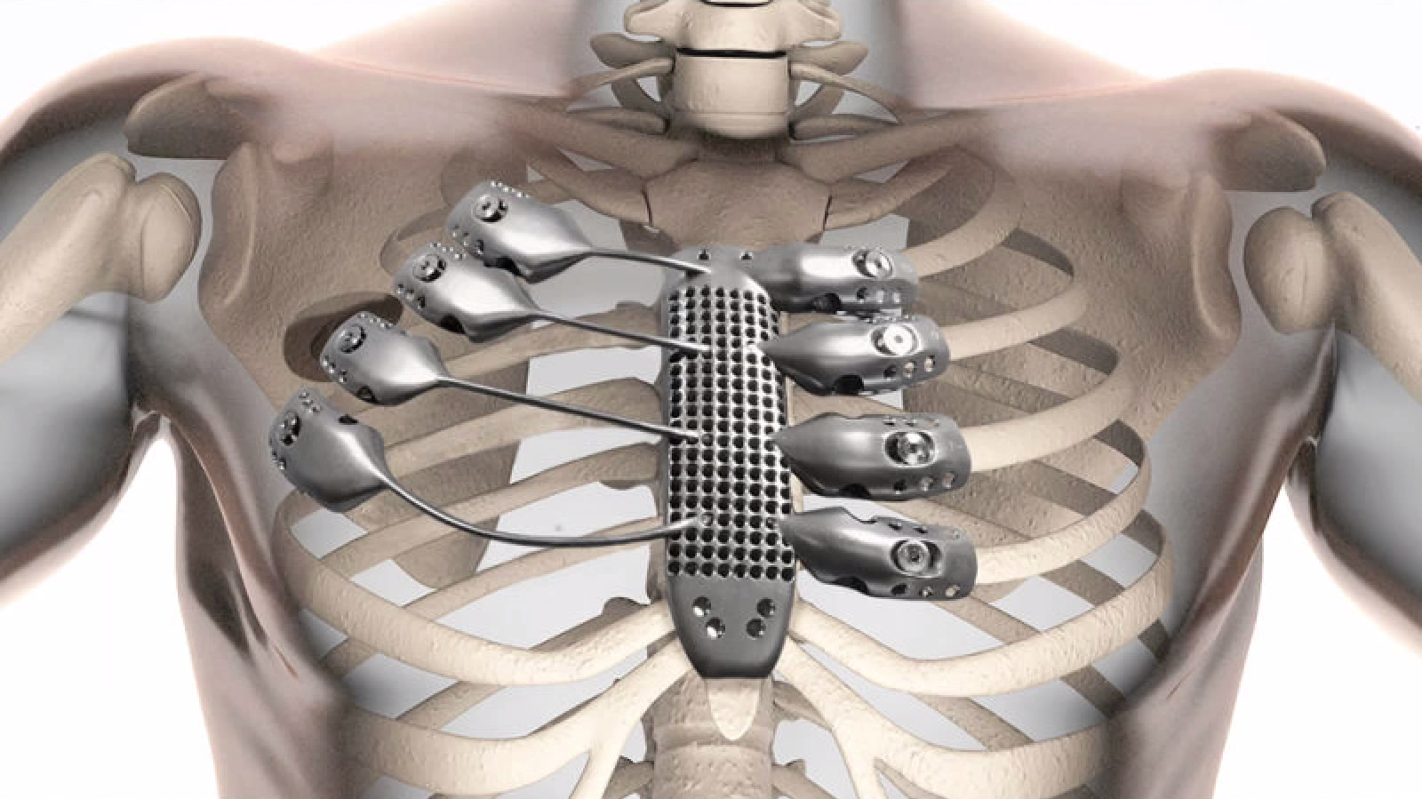 Cancer Patient Receives World’s First 3D-Printed Rib Cage Implant Thumbnail