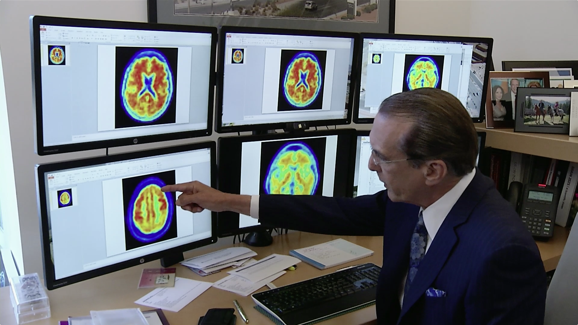 Combination Drug Treatment Reduces Agitation in Patients with Alzheimer’s Disease Thumbnail