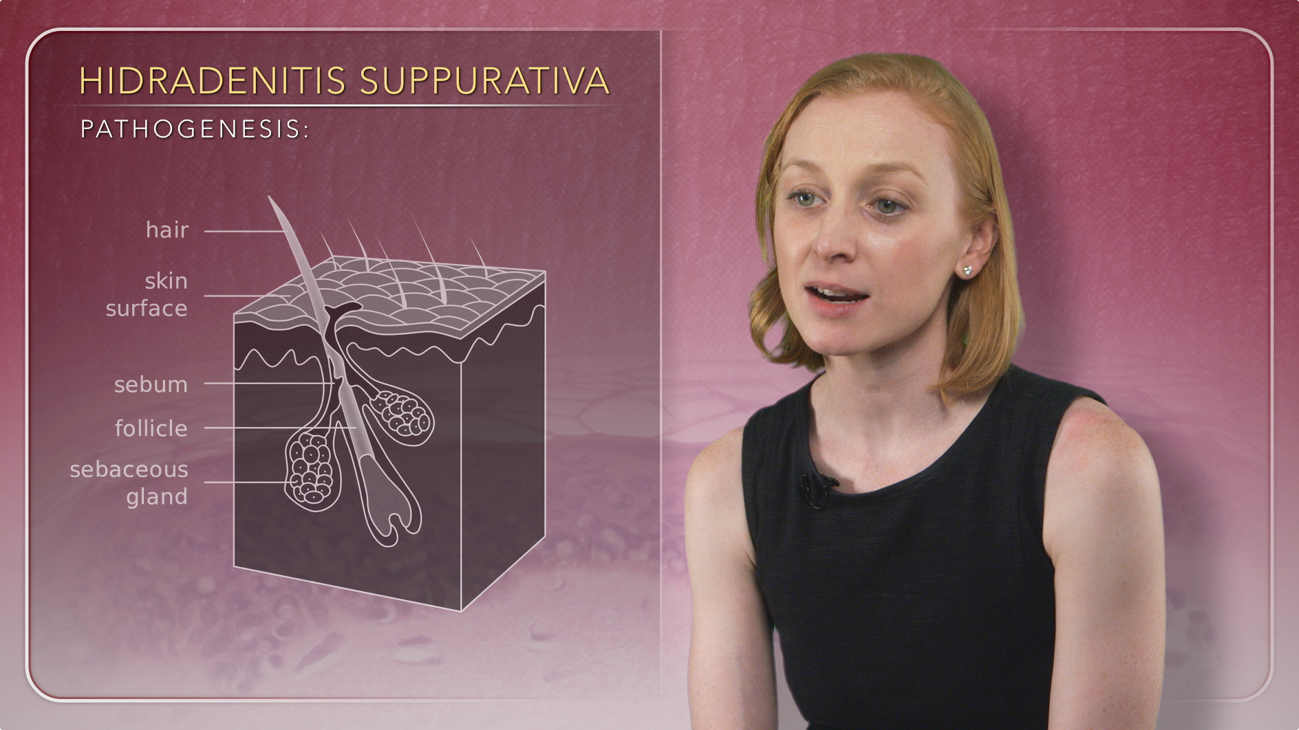 Factors Related to Pathogenesis of Hidradenitis Suppurativa Thumbnail