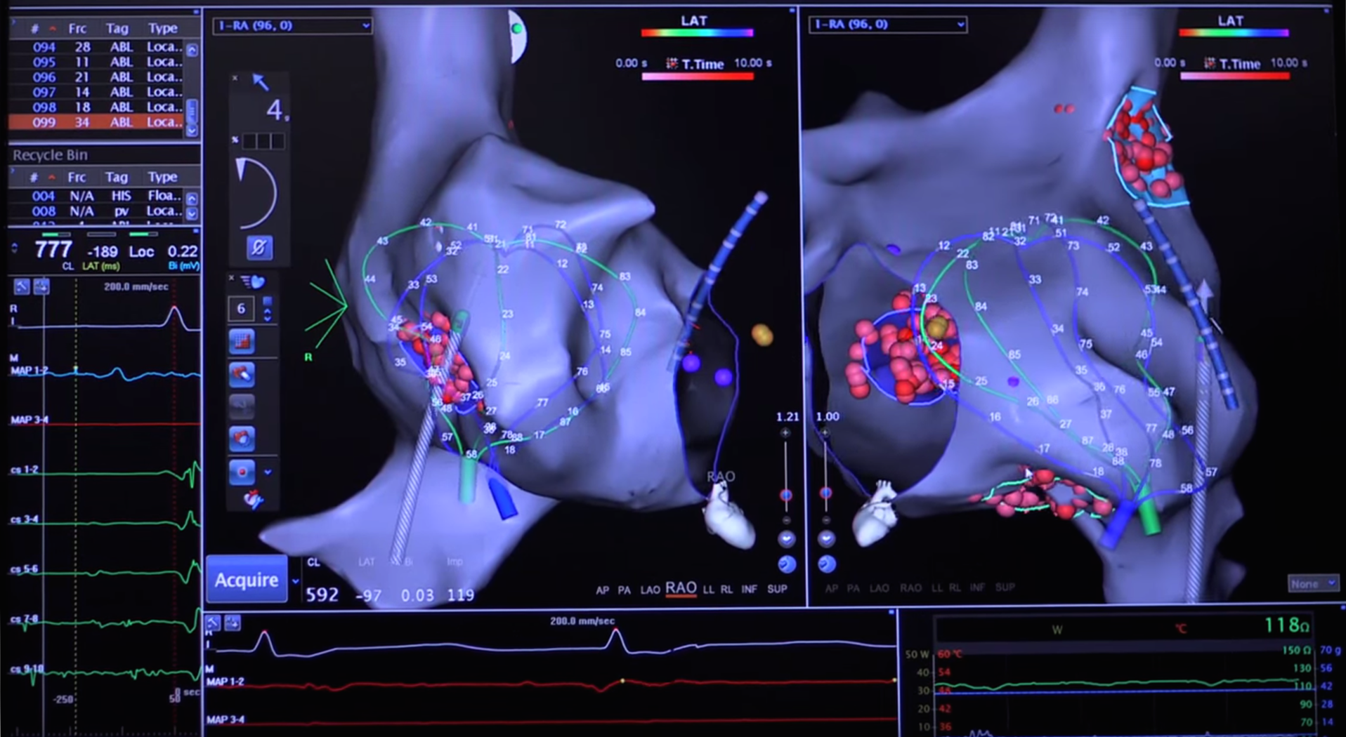 F.I.R.M. Ablation Improves Outcomes in Atrial Fibrillation Treatments Thumbnail