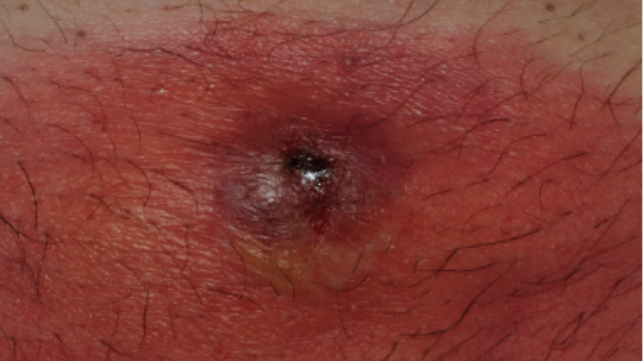 68-Year-Old Male with Painful Rash on Abdomen - The Doctor's Channel