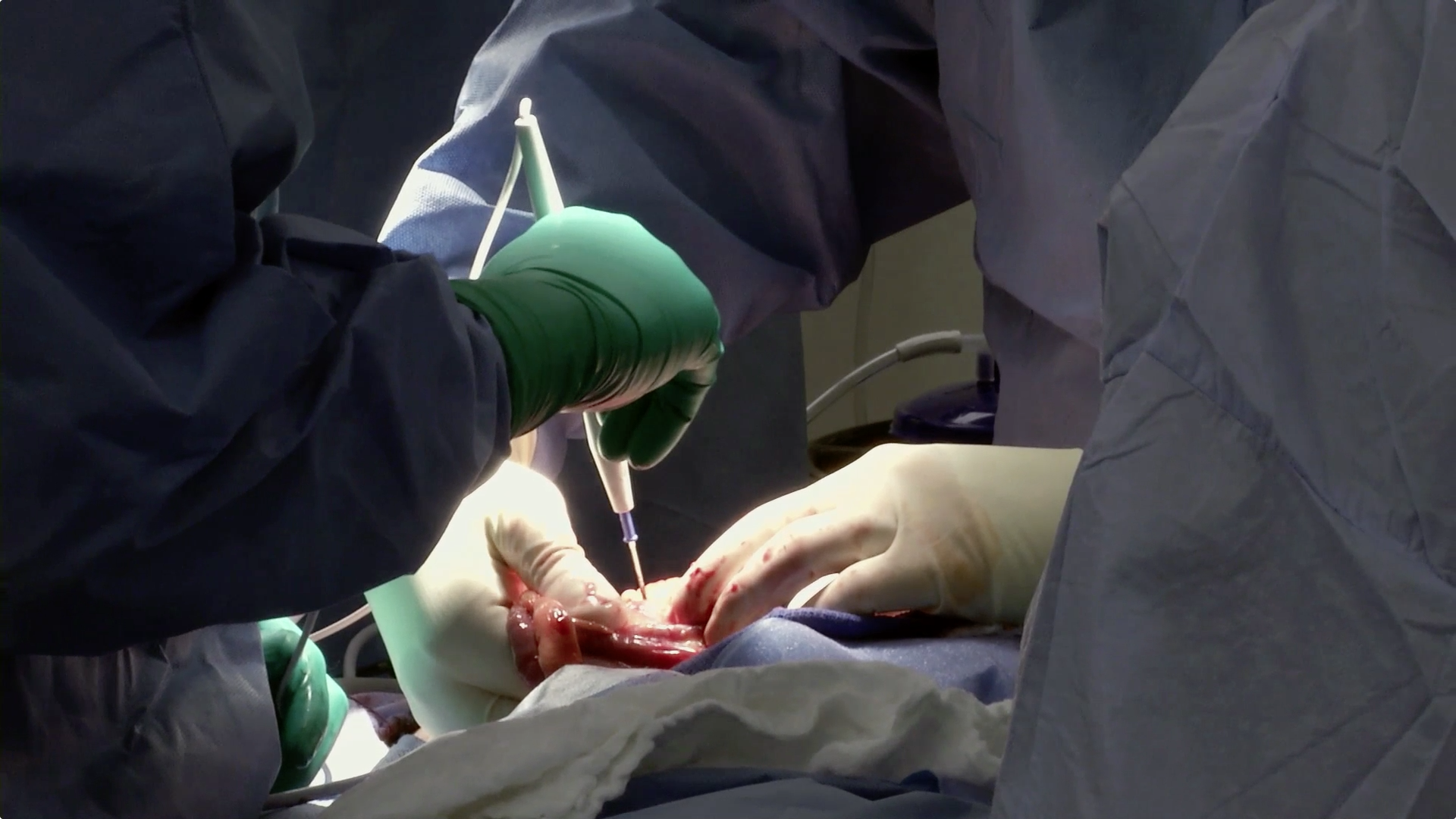Minimally Invasive Approach Not As Effective As Standard Operation for Rectal Cancer Thumbnail