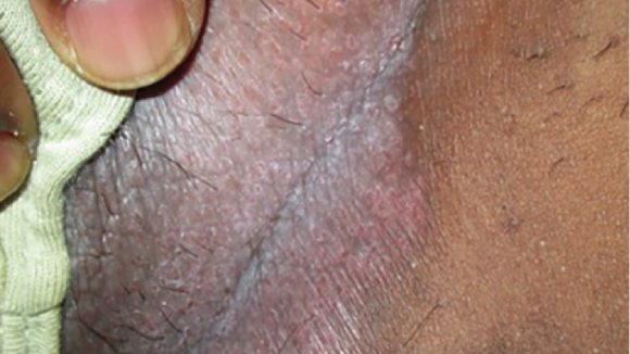 40 Year Old Male With Recurrent Erythematous Rash The Doctor S