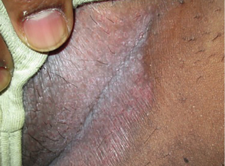 40-Year-Old Male with Recurrent Erythematous Rash - The Doctor's