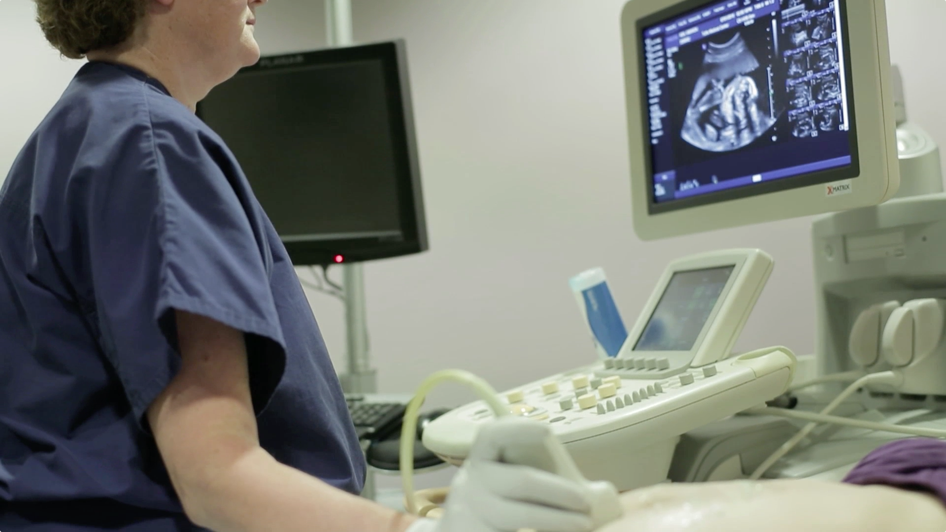 Cesarean Section Rates & Health Outcomes for Moms and Babies Thumbnail