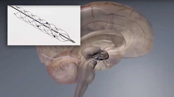 Bionic Spine May Allow Paralyzed Patients to Control Prosthetics Thumbnail
