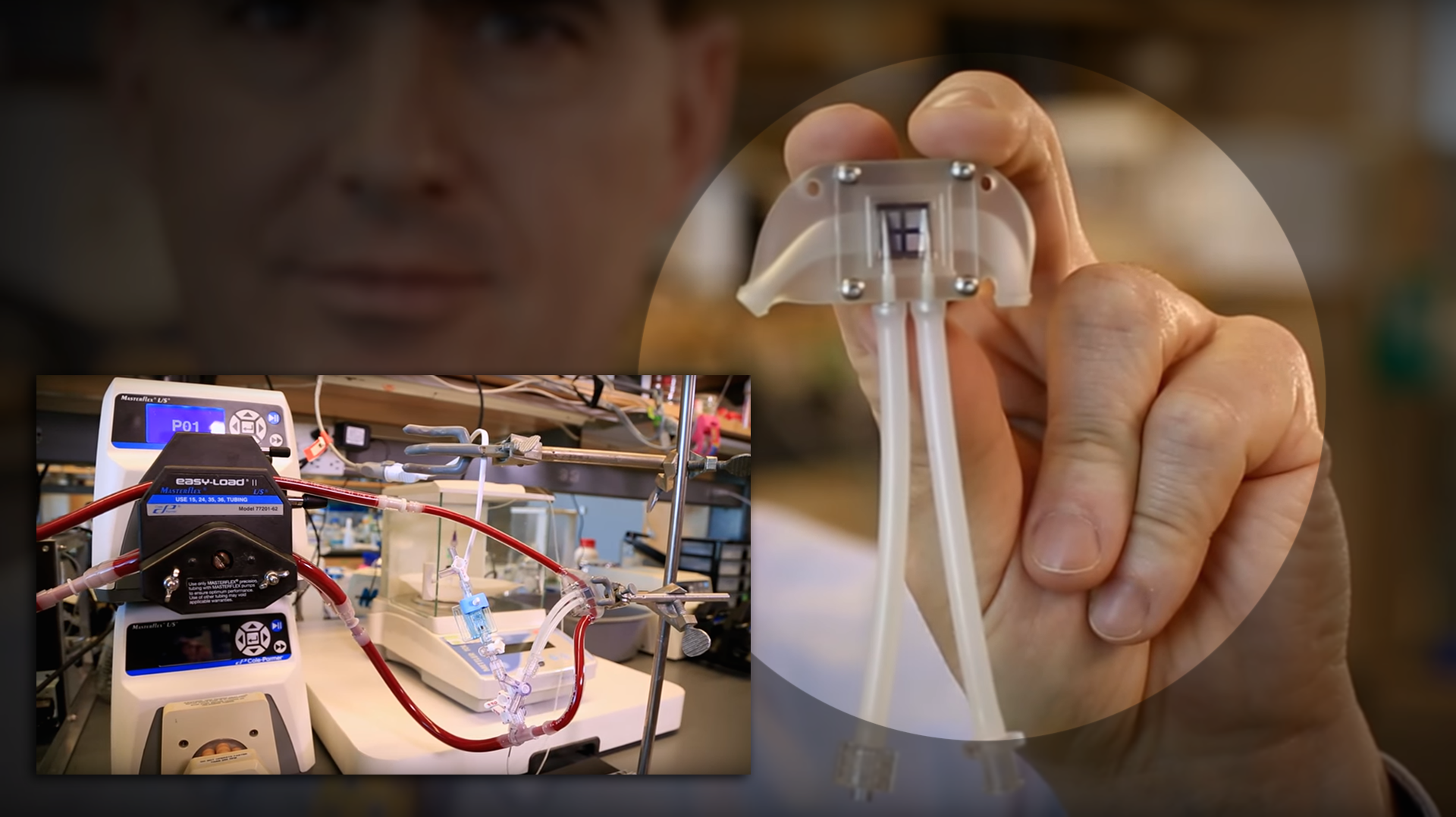 Artificial Kidney Implant Could Eliminate Need for Dialysis Thumbnail