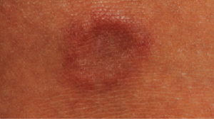 Thumbnail image for 16-Year-Old Female with Asymptomatic Bump on Ankle. Click to play.