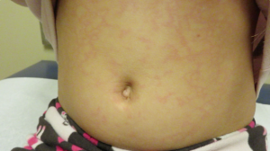 8-Year-Old Girl with Rash Following Viral Illness