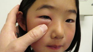 7-Year-Old Girl with Periorbital Swelling