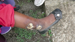 8-Year-Old Girl with Non-Healing Leg Wound