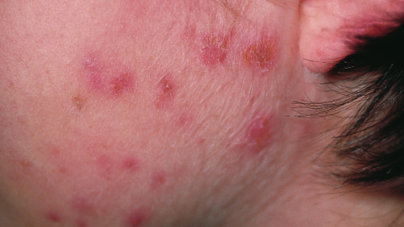 16-Year-Old Female With Spreading, Itchy Rash On Cheek - The Doctors 