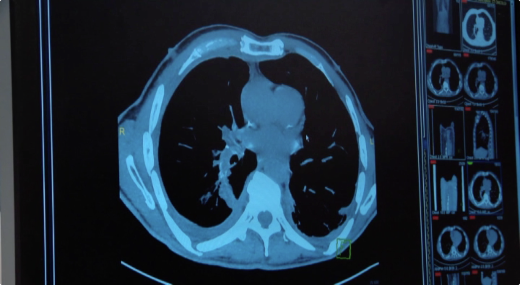 New Treatment for Advanced Melanoma Shows Promise Thumbnail