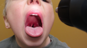 5-Year-Old Boy with Sore Throat and Headache